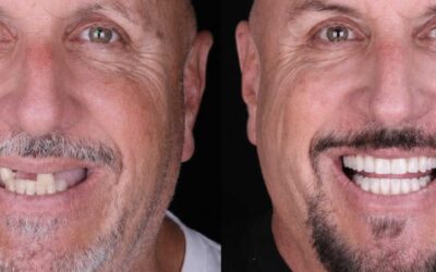 Deciding Between Full-Arch Implants and Keeping a Few Natural Teeth: How Periodontists Weigh It