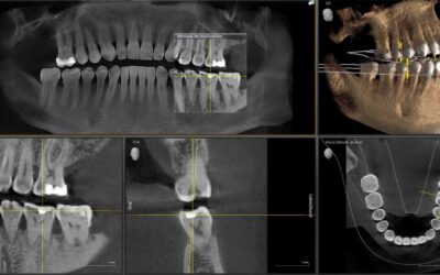 What a Graftless Full-Arch Solution Requires From Your Bone, and How That Is Assessed